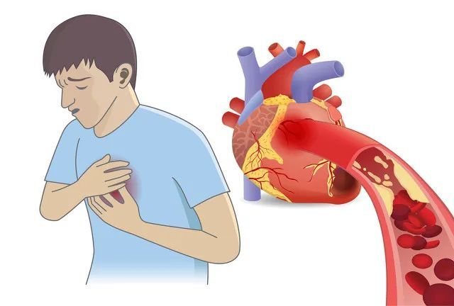 心脏病来临前的5个征兆，您知道吗？